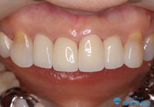 50代女性 前歯のつめものがとれた これを機に前歯をきれいにしたいの治療後