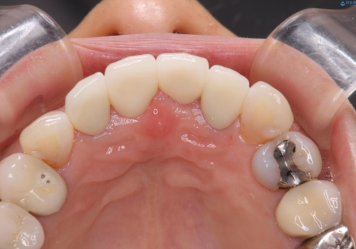 50代女性 前歯のつめものがとれた これを機に前歯をきれいにしたいの治療後