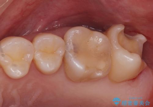 奥歯の治療の劣化が気になる。ザラザラしているの治療中