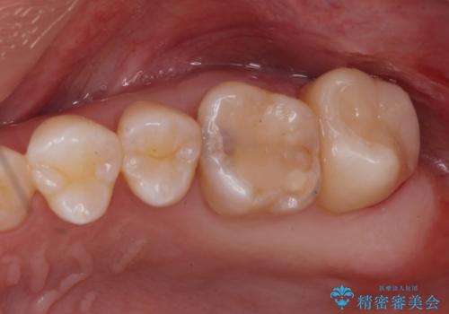 奥歯の治療の劣化が気になる。ザラザラしているの症例 治療後