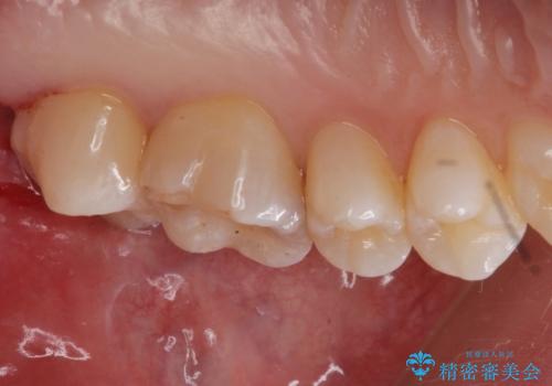 奥歯の治療の劣化が気になる。ザラザラしているの治療後