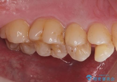 歯と歯の間の虫歯(コンタクトカリエス)の治療中