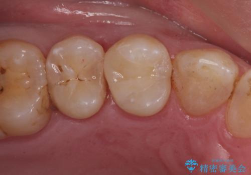歯と歯の間の虫歯(コンタクトカリエス)の治療後