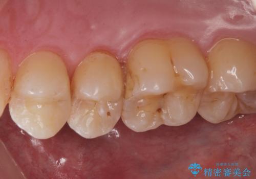 歯と歯の間の虫歯(コンタクトカリエス)の治療後