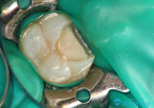 【VPT(歯髄温存療法)とセラミックインレー】深い虫歯でも神経を残したいの治療中