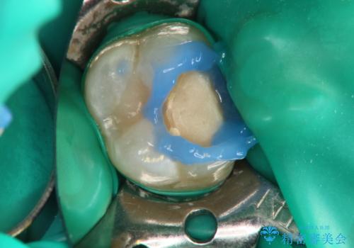 【VPT(歯髄温存療法)とセラミックインレー】深い虫歯でも神経を残したいの治療中