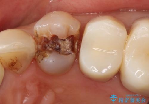 【オールセラミッククラウン】銀歯の下に大きな虫歯の治療前