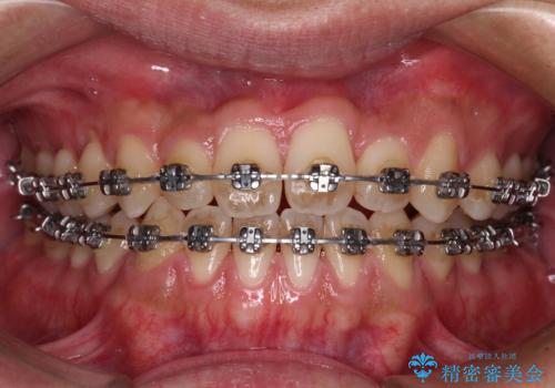 前歯のクロスバイトをワイヤー矯正で　結婚式までに治したいの治療中