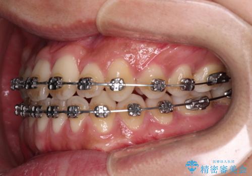 前歯のクロスバイトをワイヤー矯正で　結婚式までに治したいの治療中