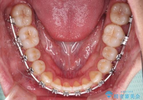 前歯のクロスバイトをワイヤー矯正で 結婚式までに治したいの治療中