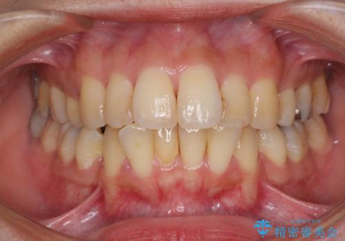 後戻りで突出した前歯をインビザラインで解消の症例 治療前