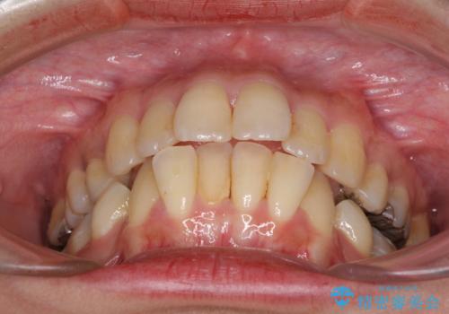 後戻りで突出した前歯をインビザラインで解消の治療前