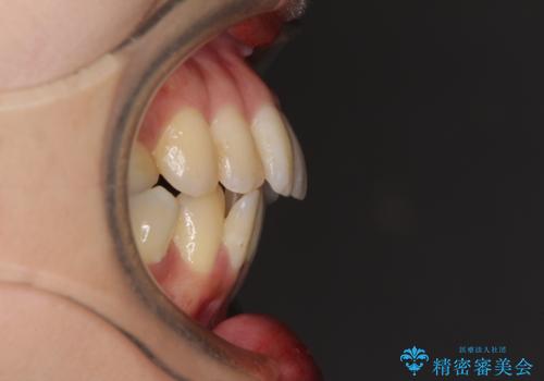 後戻りで突出した前歯をインビザラインで解消の治療前