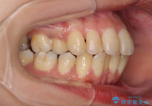 後戻りで突出した前歯をインビザラインで解消の治療前