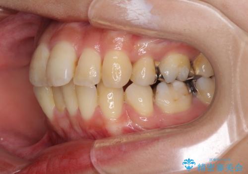 後戻りで突出した前歯をインビザラインで解消の治療前