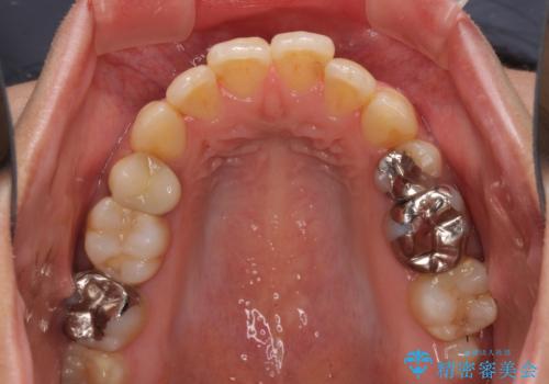 後戻りで突出した前歯をインビザラインで解消の治療前