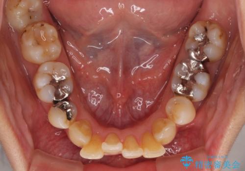 後戻りで突出した前歯をインビザラインで解消の治療前