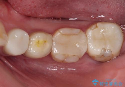 見た目の不揃いなセラミックを統一感のある歯にの治療前