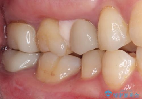 見た目の不揃いなセラミックを統一感のある歯にの治療前