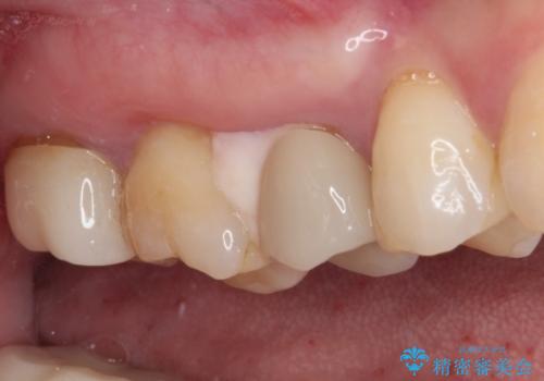 見た目の不揃いなセラミックを統一感のある歯にの治療前