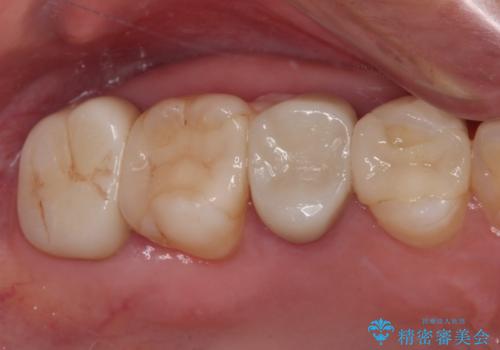 見た目の不揃いなセラミックを統一感のある歯にの治療前