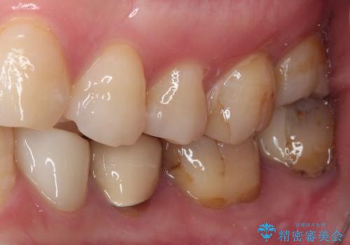 見た目の不揃いなセラミックを統一感のある歯にの治療前
