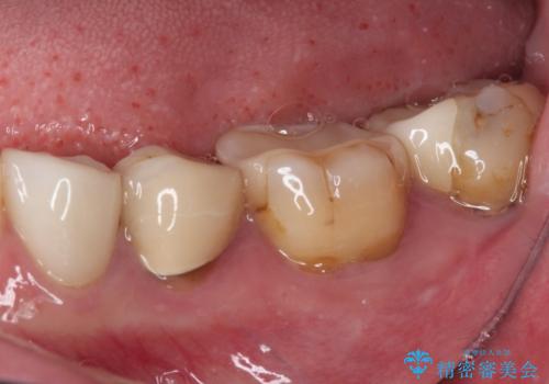 見た目の不揃いなセラミックを統一感のある歯にの治療前