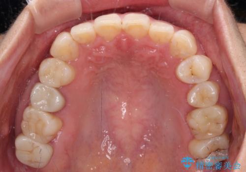 見た目の不揃いなセラミックを統一感のある歯にの治療前