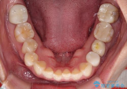 見た目の不揃いなセラミックを統一感のある歯にの治療前