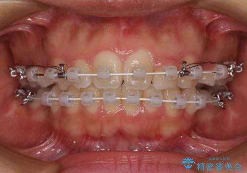 【モニター】閉じにくい口元 ワイヤー装置での抜歯矯正の治療中