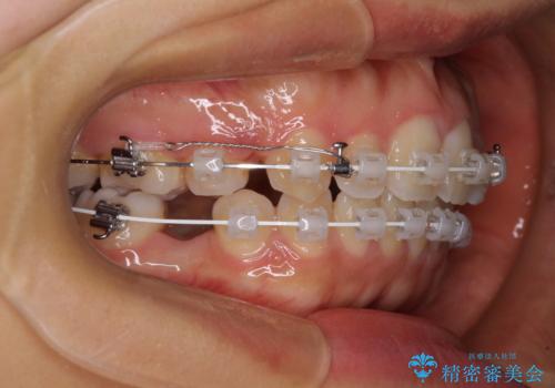 【モニター】閉じにくい口元 ワイヤー装置での抜歯矯正の治療中