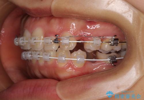 【モニター】閉じにくい口元 ワイヤー装置での抜歯矯正の治療中