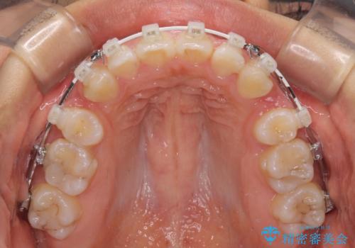 【モニター】閉じにくい口元 ワイヤー装置での抜歯矯正の治療中