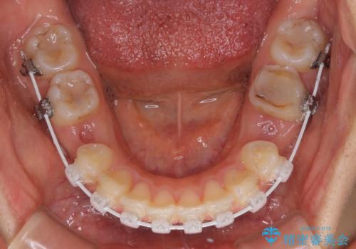 【モニター】閉じにくい口元 ワイヤー装置での抜歯矯正の治療中