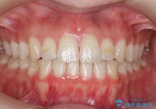 下の歯のがたつき 上より気になるの治療後