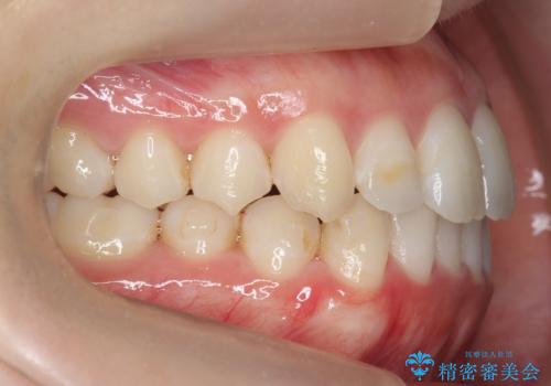 下の歯のがたつき 上より気になるの治療後