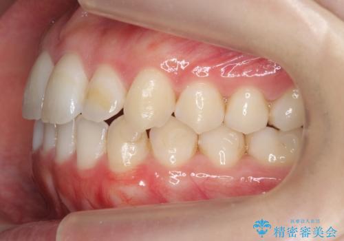 下の歯のがたつき 上より気になるの治療後