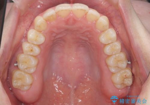 下の歯のがたつき 上より気になるの治療後