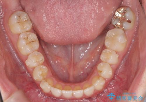 下の歯のがたつき 上より気になるの治療後