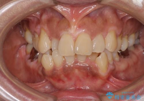 クロスバイトの前歯を治したい ワイヤー装置でも抜歯矯正の症例 治療前