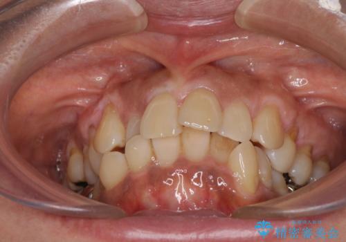 クロスバイトの前歯を治したい ワイヤー装置でも抜歯矯正の治療前