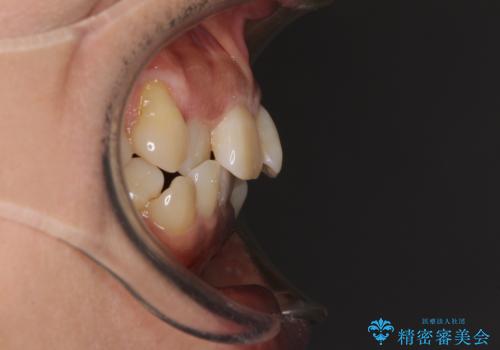 クロスバイトの前歯を治したい ワイヤー装置でも抜歯矯正の治療前