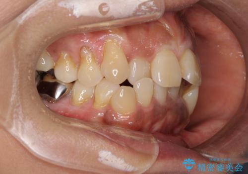 クロスバイトの前歯を治したい ワイヤー装置でも抜歯矯正の治療前