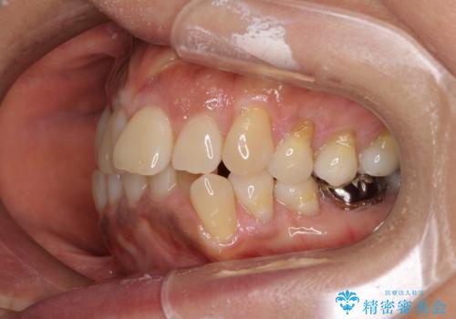 クロスバイトの前歯を治したい　ワイヤー装置でも抜歯矯正の治療前