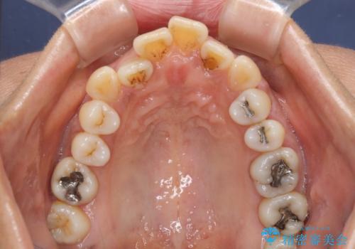 クロスバイトの前歯を治したい ワイヤー装置でも抜歯矯正の治療前