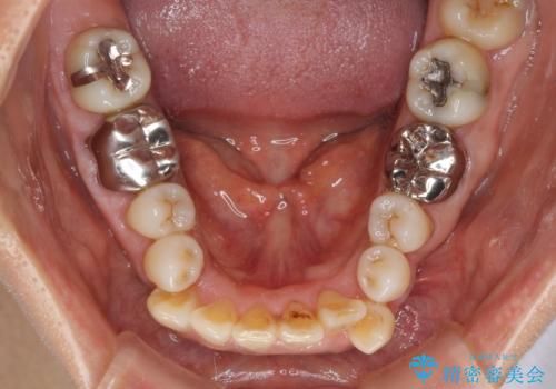 クロスバイトの前歯を治したい　ワイヤー装置でも抜歯矯正の治療前