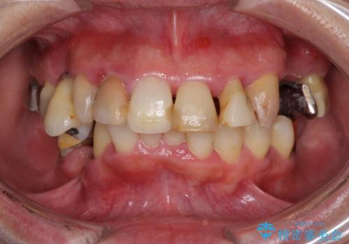 歯周病で痛い　全顎的歯周病治療の症例 治療前