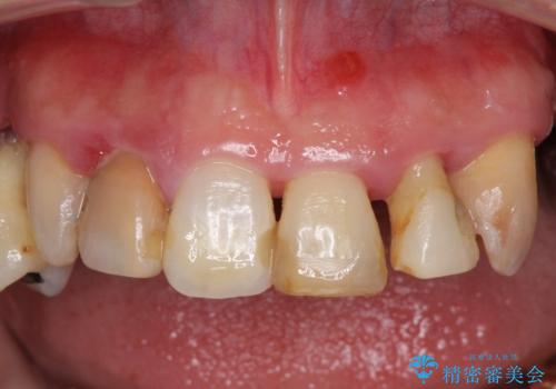 歯周病で痛い 全顎的歯周病治療の治療前