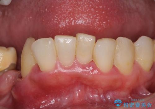 歯周病で痛い　全顎的歯周病治療の治療前