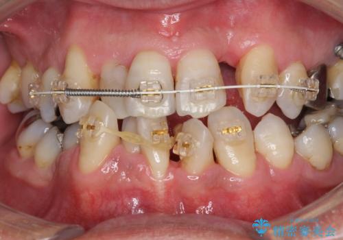 受け口 なんと部分矯正で治るんです!! インプラントを含めた総合歯科治療の治療中